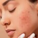 علت بروز جوش و آکنه در بزرگسالی چیست؟