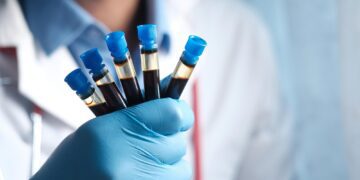 آزمایش خون جدید تشخیص آلزایمر با دقت ۹۲ درصدی