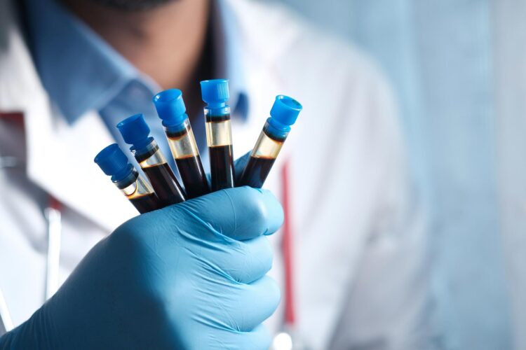 آزمایش خون جدید تشخیص آلزایمر با دقت ۹۲ درصدی
