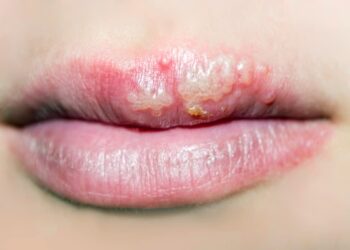 مصرف داروهای ضد تبخال ریسک آلزایمر را ۱۷ درصد کاهش می دهند