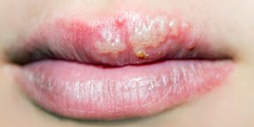 مصرف داروهای ضد تبخال ریسک آلزایمر را ۱۷ درصد کاهش می دهند