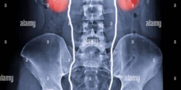 نخستین پیوند موفقیت‌آمیز مثانه انسانی در آمریکا انجام شد