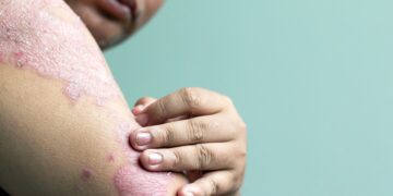 درمان هم‌زمان پسوریازیس بدن و پوست سر با فوم غیراستروئیدی روفلومیلاست