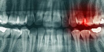 ترکیب ورزش و امگا ۳ شدت عفونت مزمن ریشه دندان را کاهش می‌ دهد