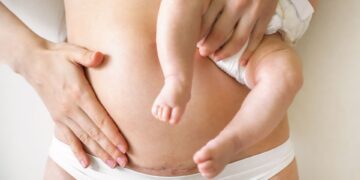 سزارین برنامه‌ریزی شده ممکن است خطر ابتلا به سرطان خون را در کودکان افزایش دهد