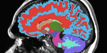 پیش‌بینی خطر زوال عقل و بیماری های مزمن میانسالی با یک اسکن مغزی جدید