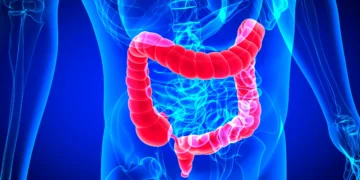 ۵ راه ساده برای کاهش خطر ابتلا به بیماری دیورتیکولیت در سنین بالا