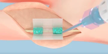 پلیمر زیست‌سازگار MIT جایگزین بخیه در جراحی‌ ها شد