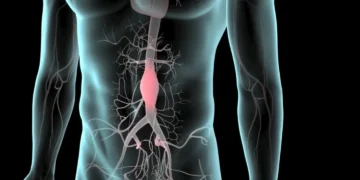 یک ترکیب شیمیایی مضر در گوشت قرمز خطر آنوریسم آئورت شکمی را سه برابر می کند