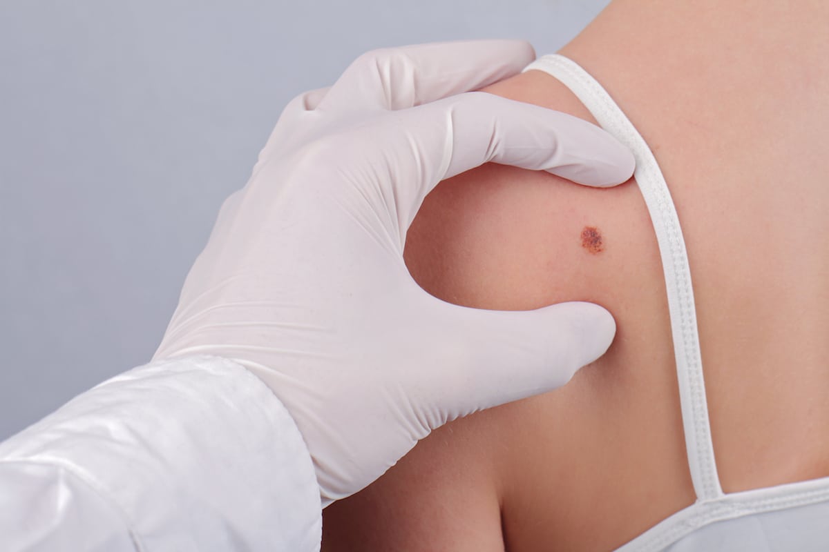 ویروس بتا-HPV نقش مهمی در بروز رایج ترین نوع سرطان پوست دارد