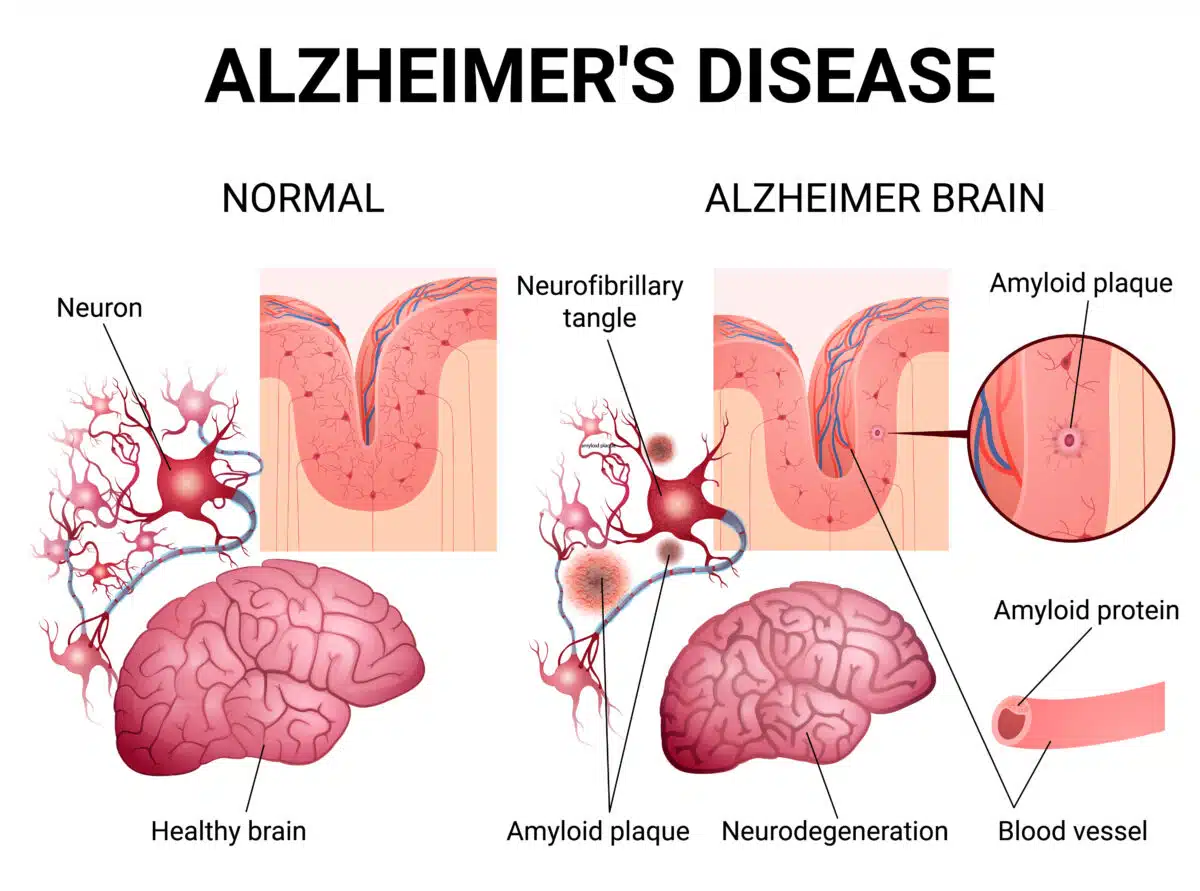 امکان تشخیص دقیق آلزایمر در ۱۱ دقیقه با یک تست ساده روی تبلت
