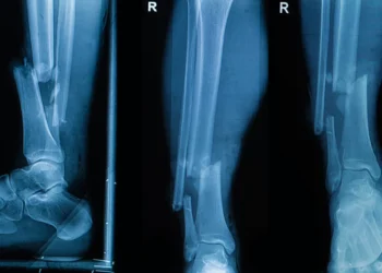 چاپ استخوان برای پیوند با دستگاهی مشابه چسب حرارتی تفنگی