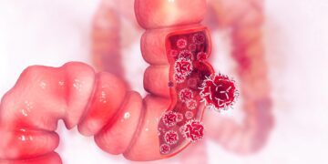 روشی جدید برای تشخیص سرطان روده بزرگ با دقت ۹۰ درصدی