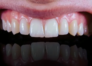 نقش چشمگیر رژیم مدیترانهای در پیشگیری از بیماری های لثه