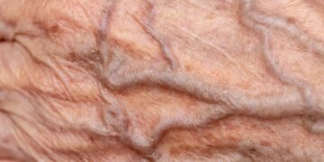 کووید-۱۹ می تواند روند پیری عروق خونی را تا پنج سال تسریع کند