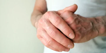 پیری زودرس سیستم ایمنی، پیش ‌بینی ‌کننده روماتیسم مفصلی در مراحل اولیه است