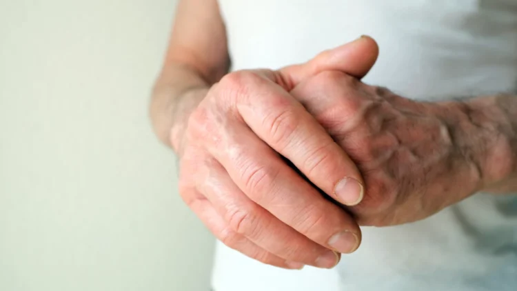 پیری زودرس سیستم ایمنی، پیش ‌بینی ‌کننده روماتیسم مفصلی در مراحل اولیه است