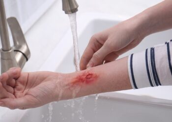 سوختگی را با یخ سرد کنیم یا آب معمولی؟