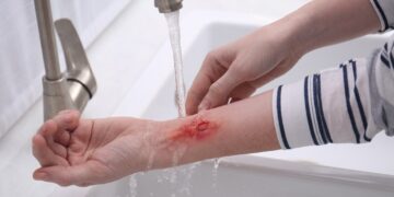 سوختگی را با یخ سرد کنیم یا آب معمولی؟