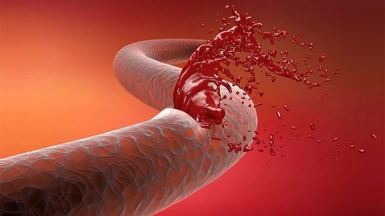 توقف خونریزی شدید در کمتر از یک دقیقه با فناوری ایرانی