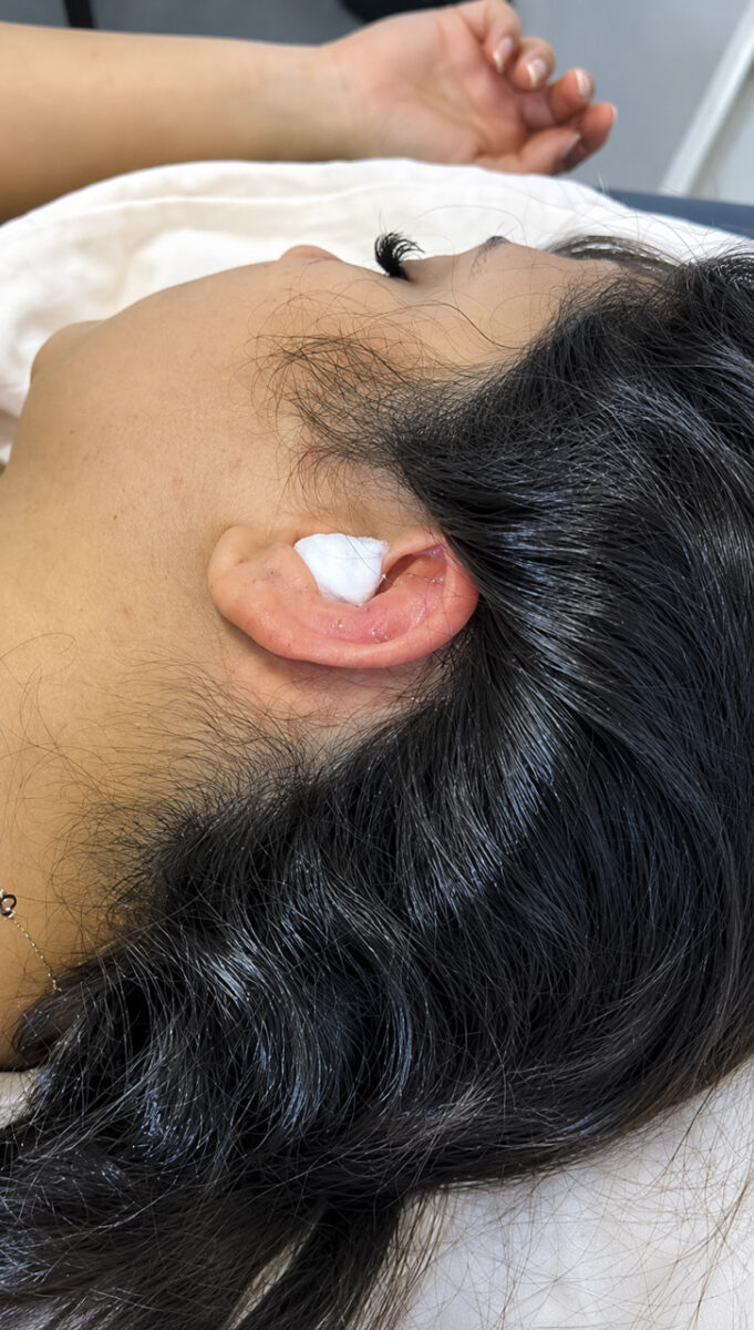 طب سوزنی گوش روشی جدید برای کاهش درد میگرن بدون دارو