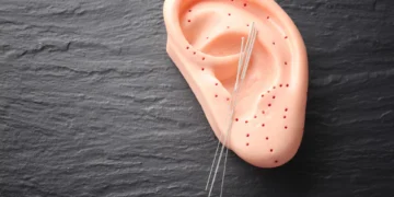 کاهش درد میگرن بدون دارو؛ طب سوزنی گوش زیر ذره‌بین پژوهشگران